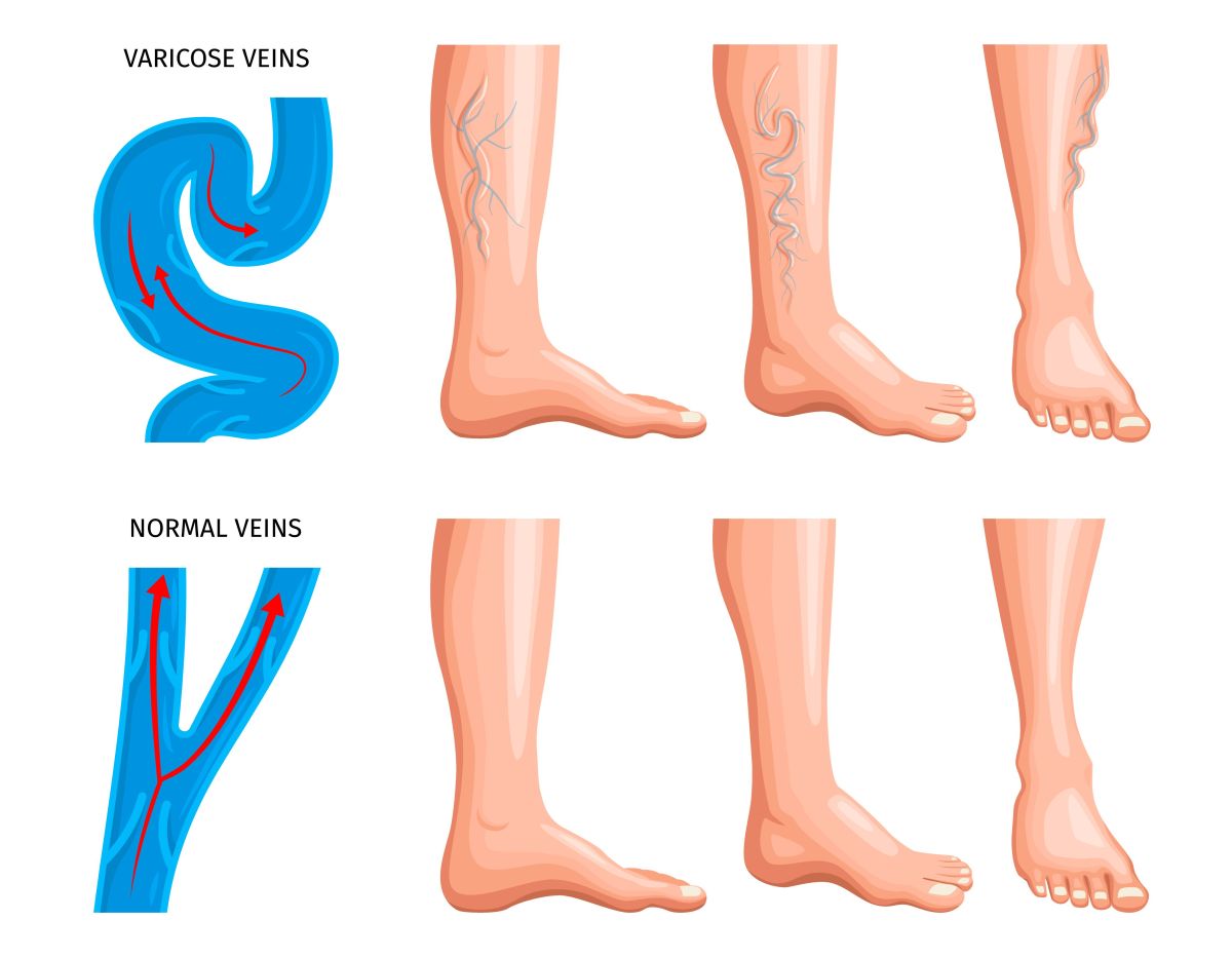 křečové zíly, varixy na nohou anatomie